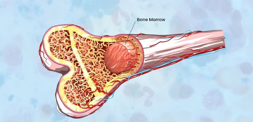 bone-marrow-transplant